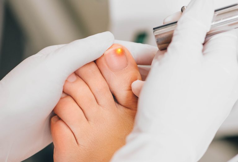 Eingewachsener Zehennagel: geröteter, geschwollener Nagelwall am großen Zeh bei der fachärztlichen Untersuchung