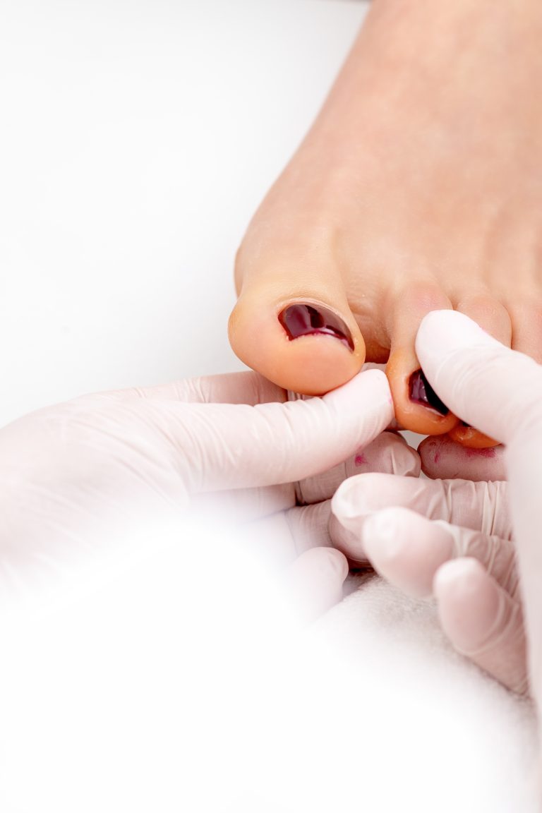 Fachärztliche Untersuchung eines eingewachsenen Zehennagels am großen Zeh