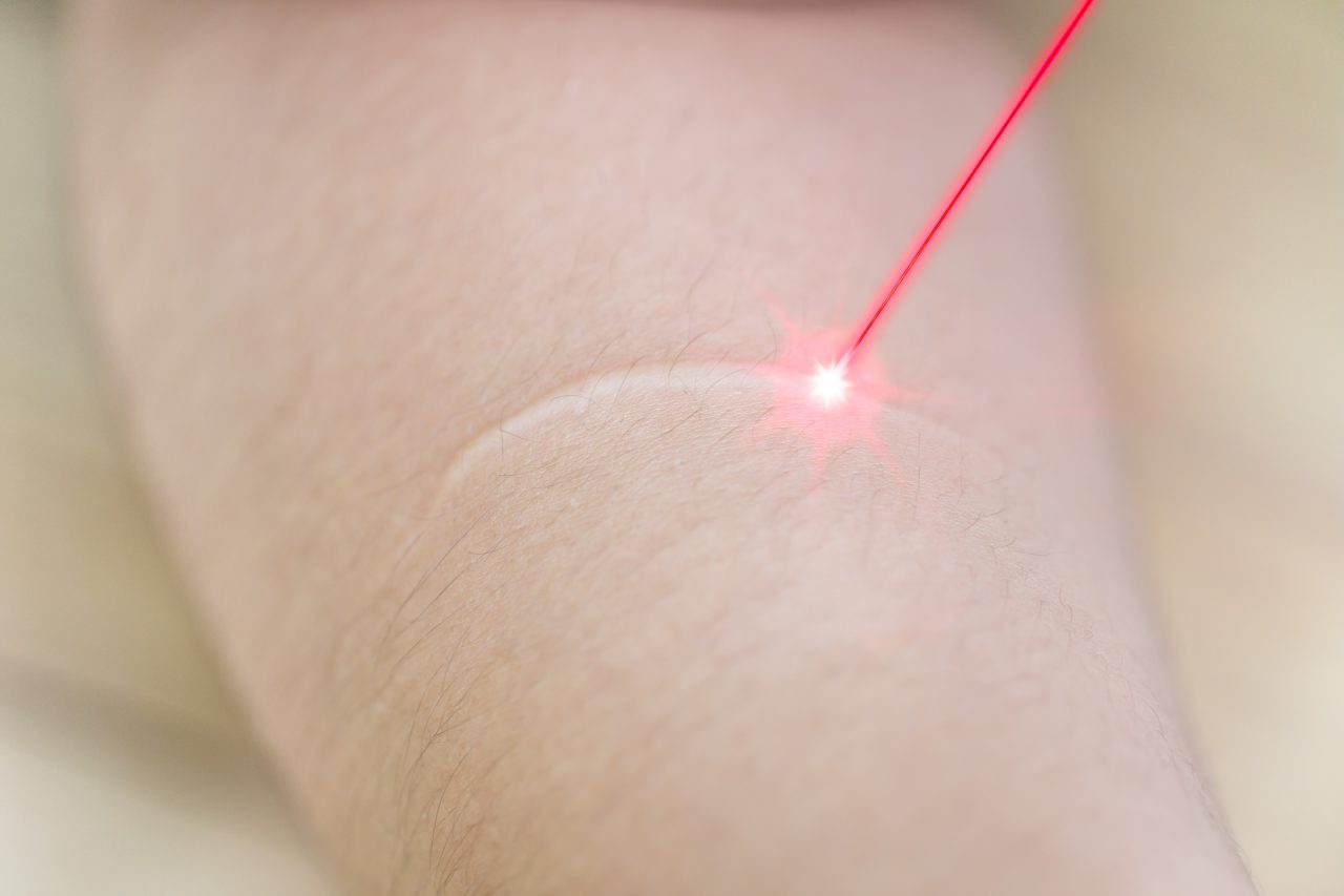 laser